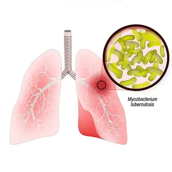 Tuberculosis (TB) - Symptoms, Types, Causes & Diagnosis